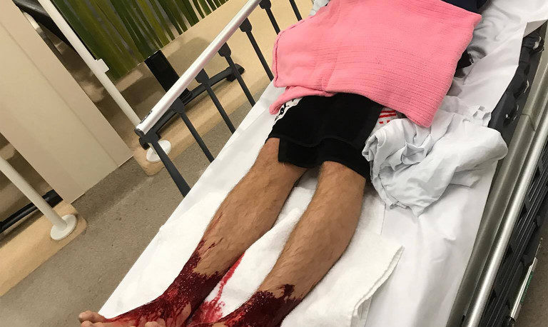 オーストラリアのメルボン郊外にある海に入った少年の足に無数の小さな穴